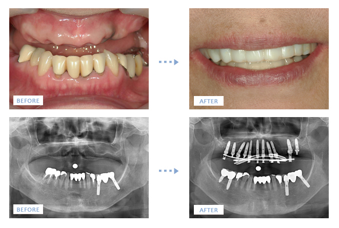 インプラントの症例 愛知県岡崎市の歯科 歯医者 医療法人康生歯科医院